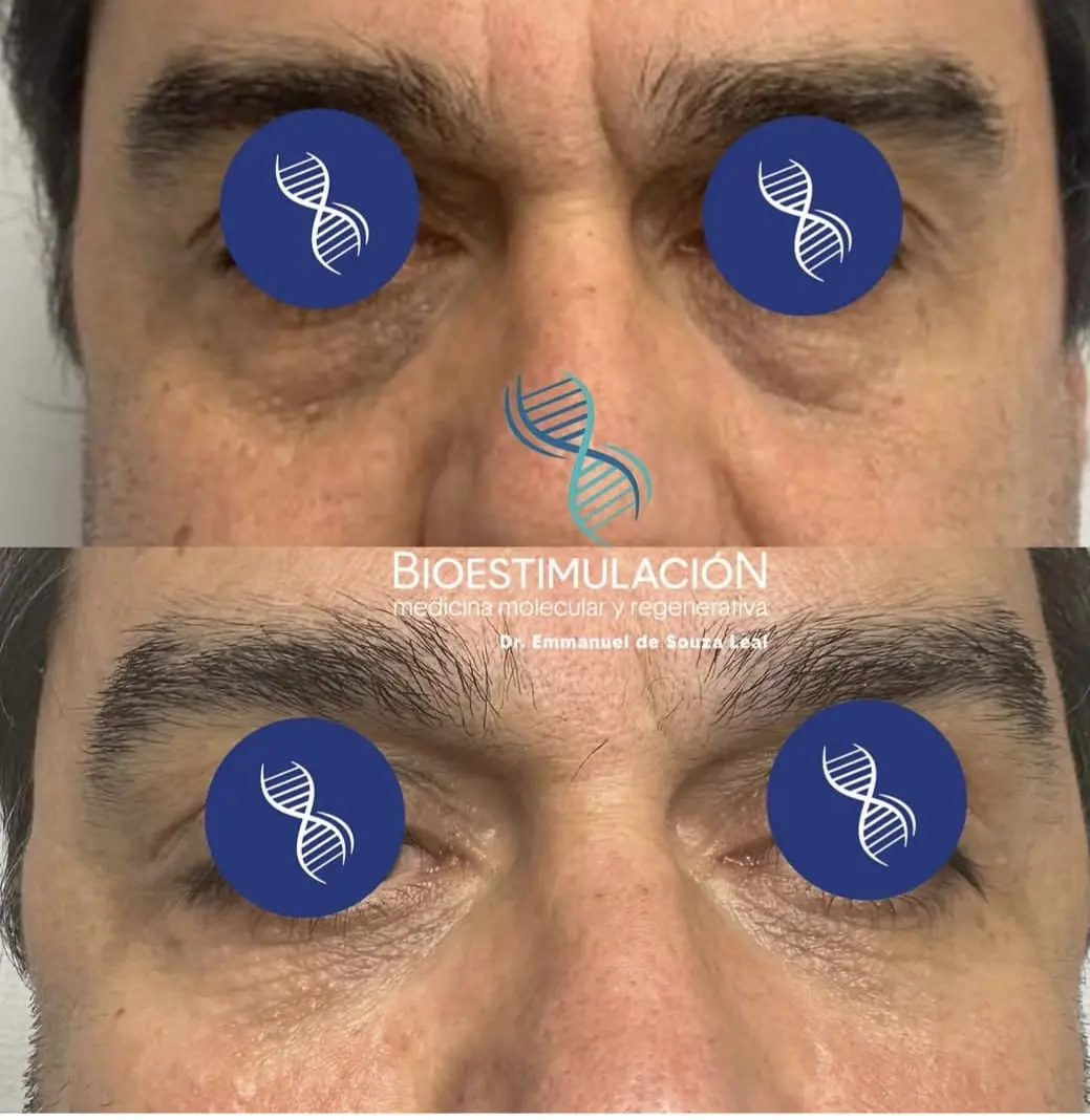 Tratamiento de Ojeras masculino - Bioestimulación